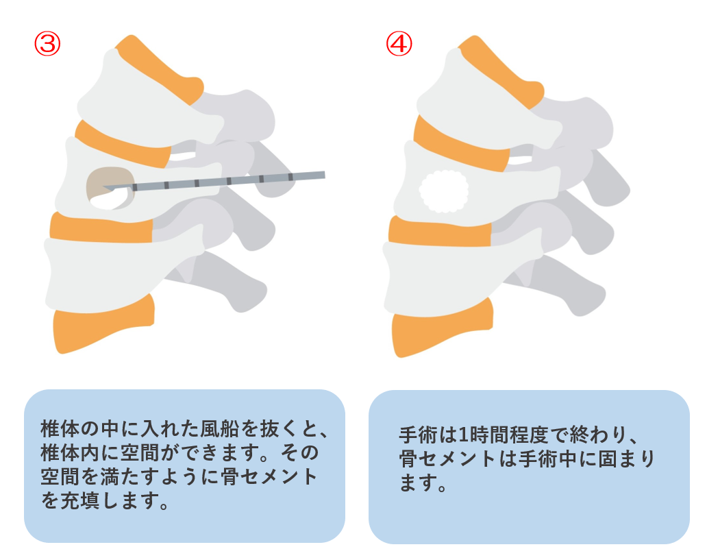 手術方法3・4