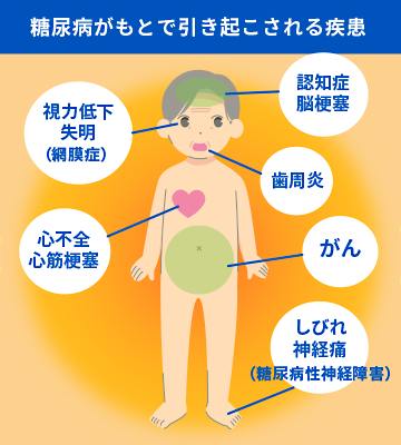 糖尿病による疾患